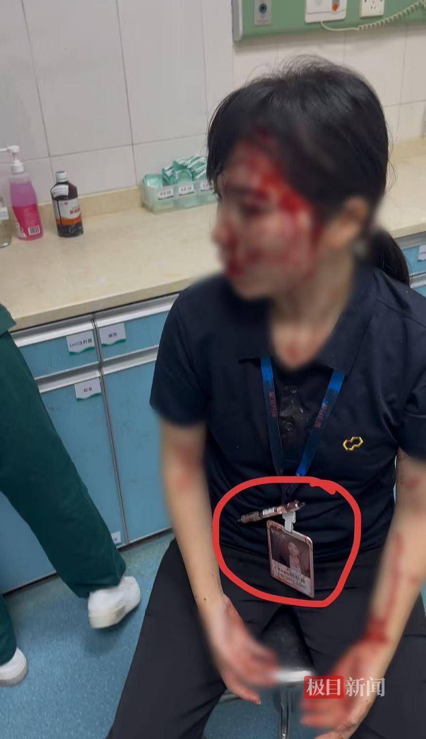 皇家苏斯达B队vs加的斯_“男子持水杯砸伤女同事被刑拘”后续：脸部缝20多针的女子已出院皇家苏斯达B队vs加的斯，否认抢单惹祸