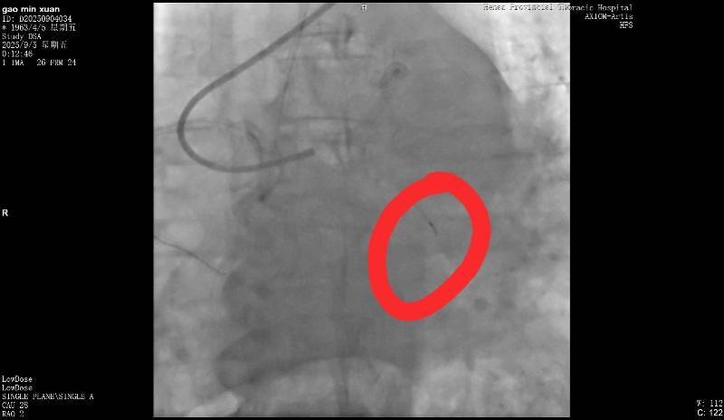 皇冠信用网在线注册_河南一老人做冠脉造影手术时一截导丝断在血管中皇冠信用网在线注册！院方回应