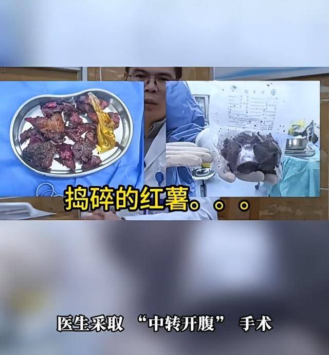 皇冠返水_61岁男子将17cm红薯塞入肛门皇冠返水，半夜疼痛难忍被迫就医，医生：尺寸过大，得开腹